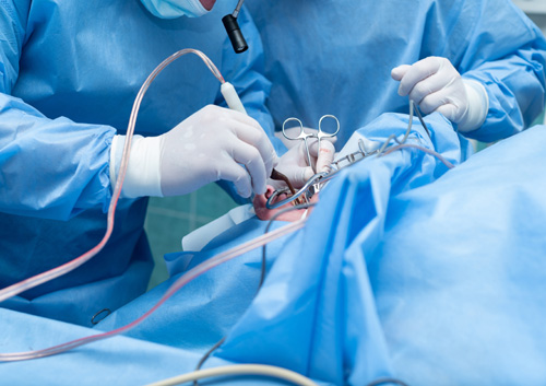 tonsillectomy