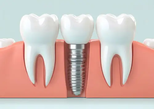 dental implant shown between two natural teeth