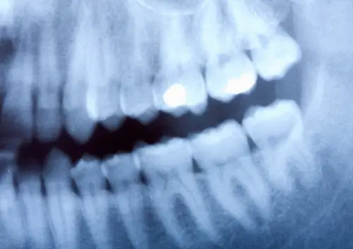 Advanced digital X-ray sensor displaying a high-resolution, instant image of a patient's dental structure on a monitor at Legacy Oral Surgery in New York and New Jersey