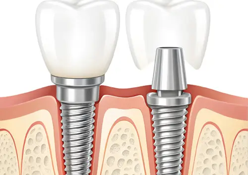 Diagram of dental implant structure showing screw, abutment, and crown fixed in jawbone.