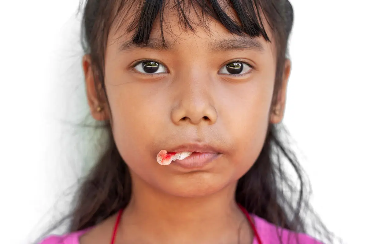 Closeup Asian little girl biting the gauze in mount to stop the bleeding after the extraction of milk teeth isolated on white background.
